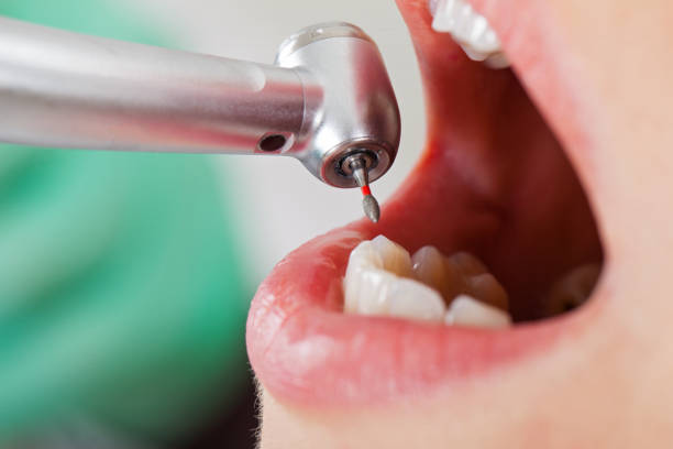 Best Emergency Root Canal Therapy in Hillsville, VA